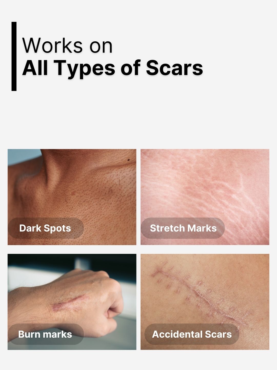 Scars Away Roll On | Reduces Scars, Stretch Marks & Uneven Skin Tone - Dazze and blussh